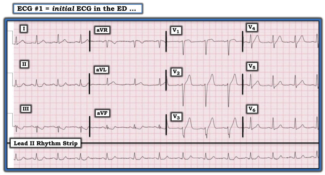 What About These T Waves? | Relias Media