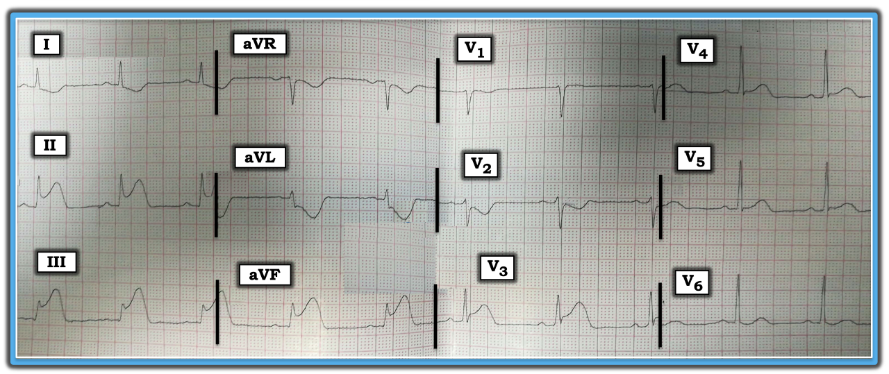 Determining the ‘Culprit’ Artery | Relias Media