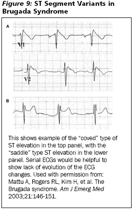 Rapid ID - EKG & Myocardial Infarction