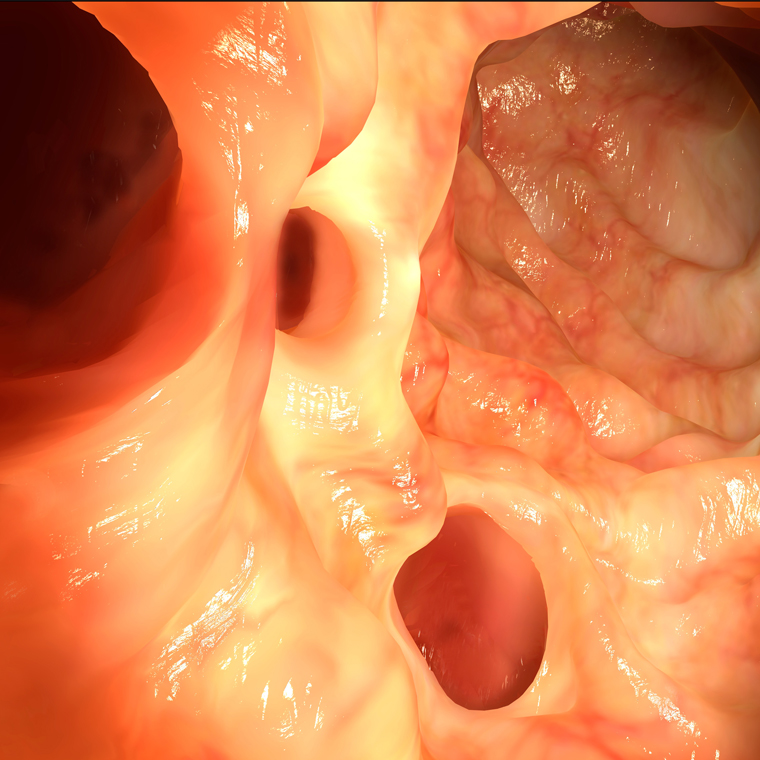 Diverticulitis: Evaluation and Management | 2015-04-17 | AHC Media