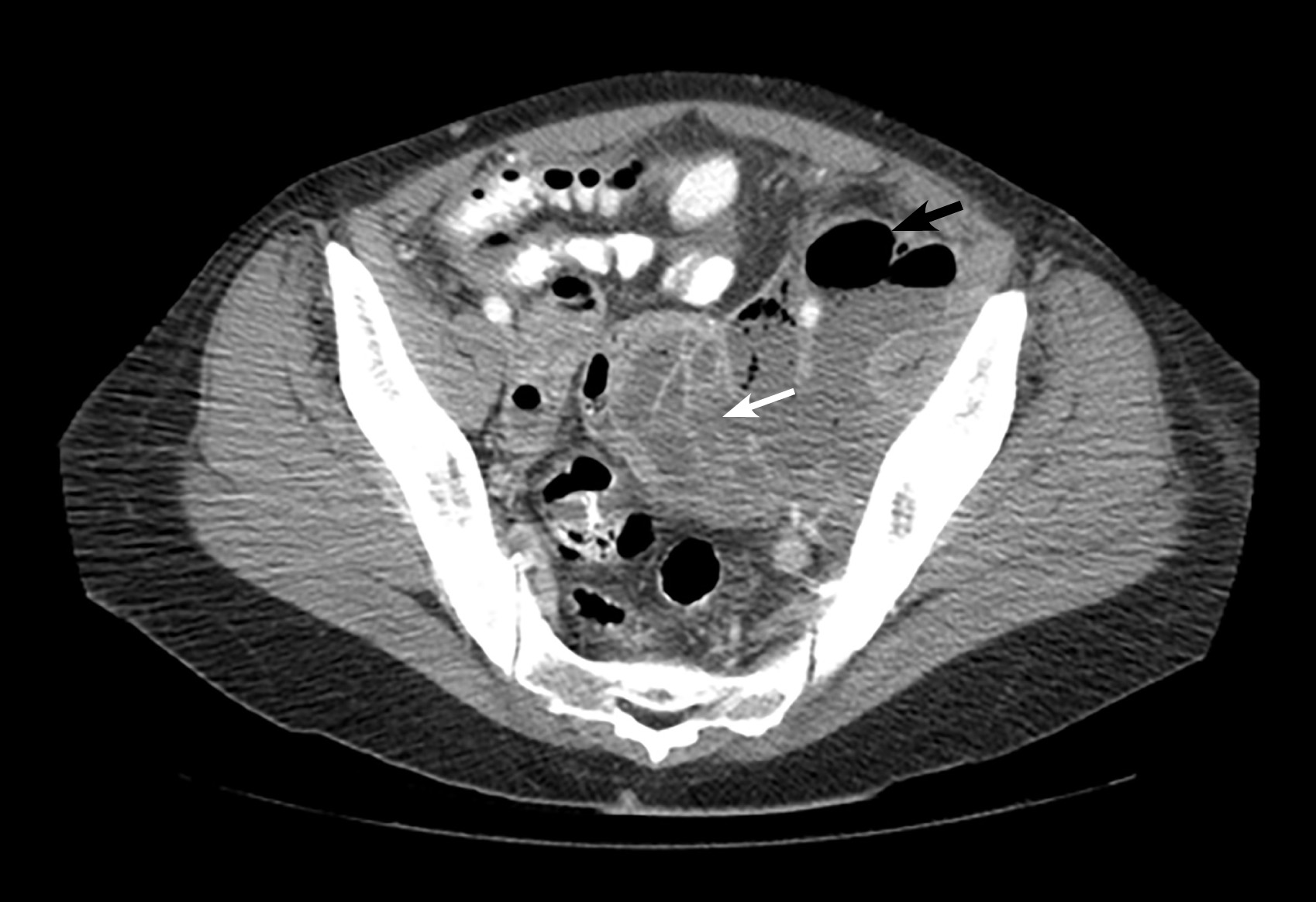 Pelvic Ct Scan Causes Symptoms Treatment Pelvic Ct Scan Bank2home