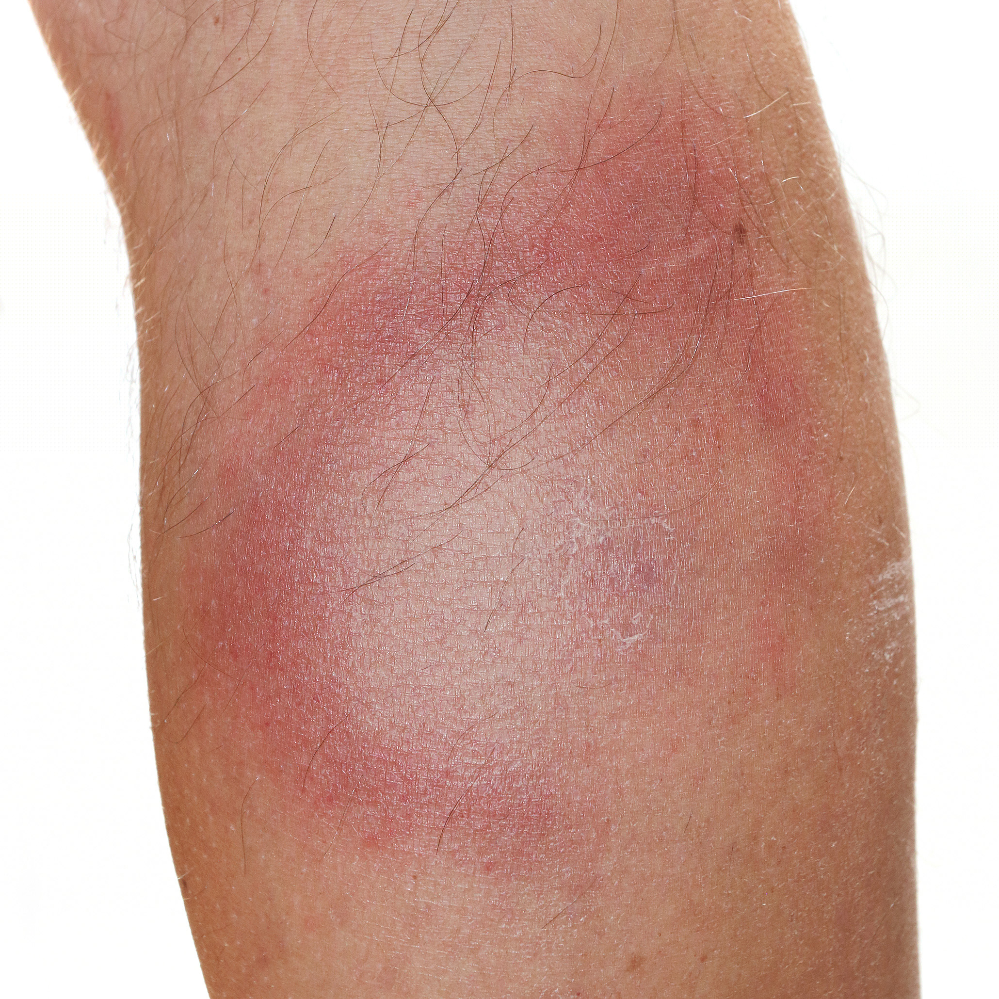 Not All Round Rashes Are Ringworm: A Differential…