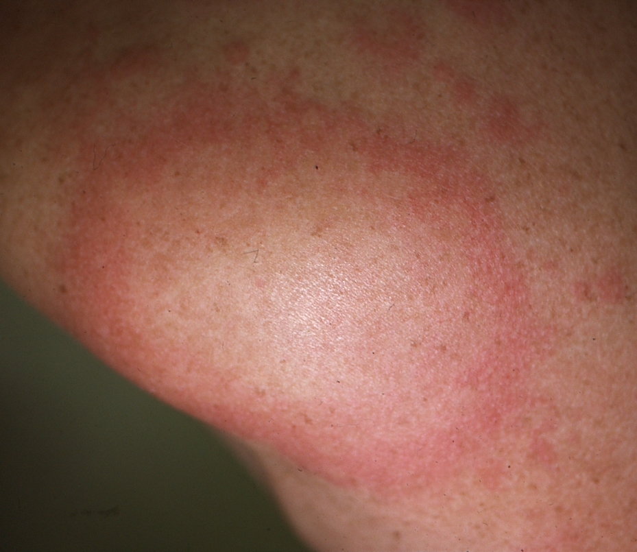 Itchy Vesicular Rash | MDedge Dermatology