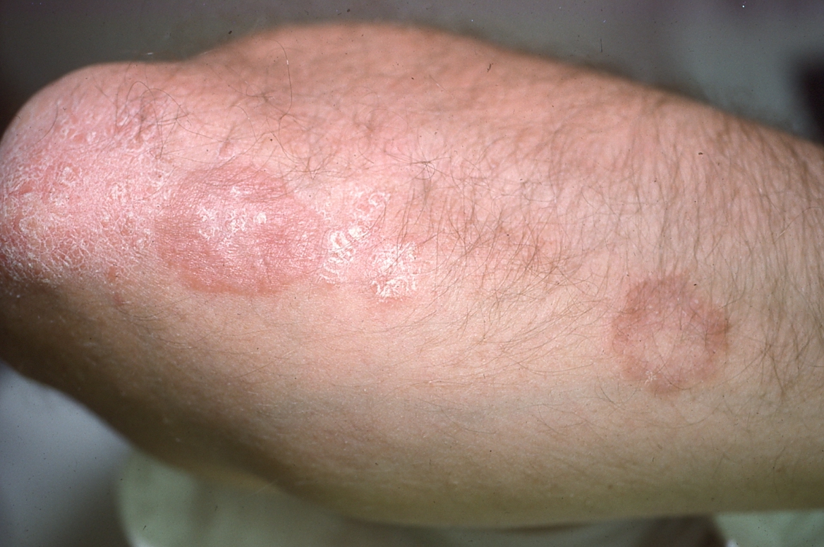 ringworm rash on arm