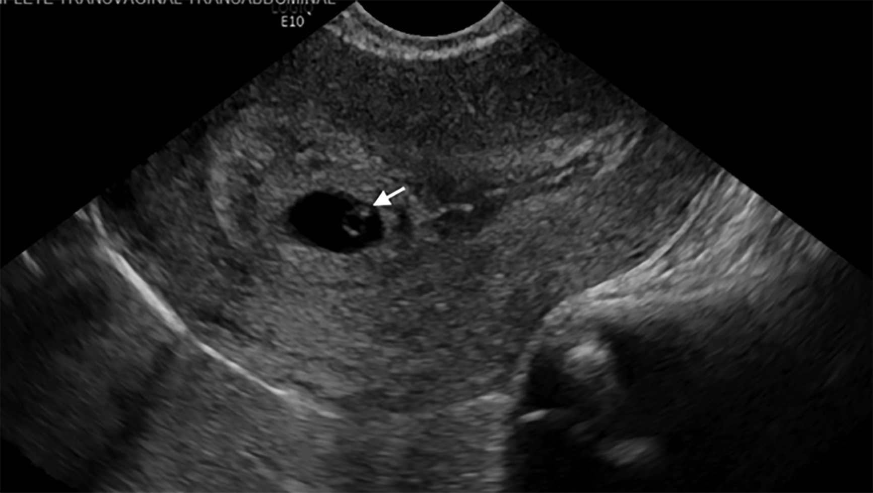 Evaluation And Management Of Ectopic Pregnancy In The Emergency 