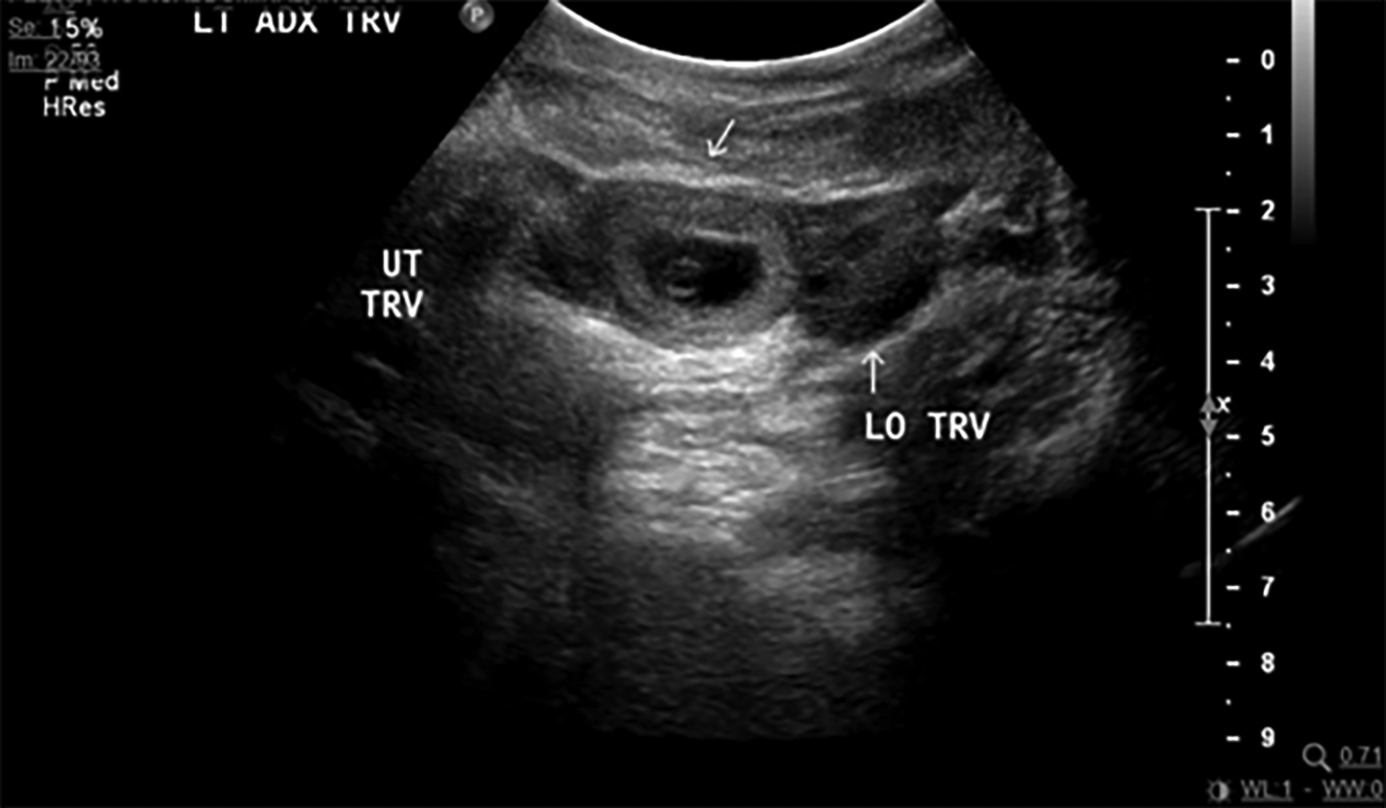 Differential-diagnostic and therapeutic challenges in the management of  ruptured corpus luteum cyst with undiagnosed intrauterine pregnancy in the  early first trimester and ruptured ovarian pregnancy
