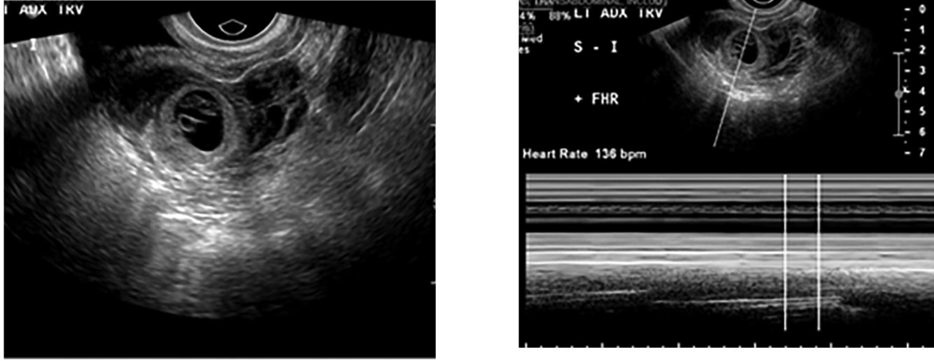 Hemoperitoneum from ruptured heterotopic pregnancy covering