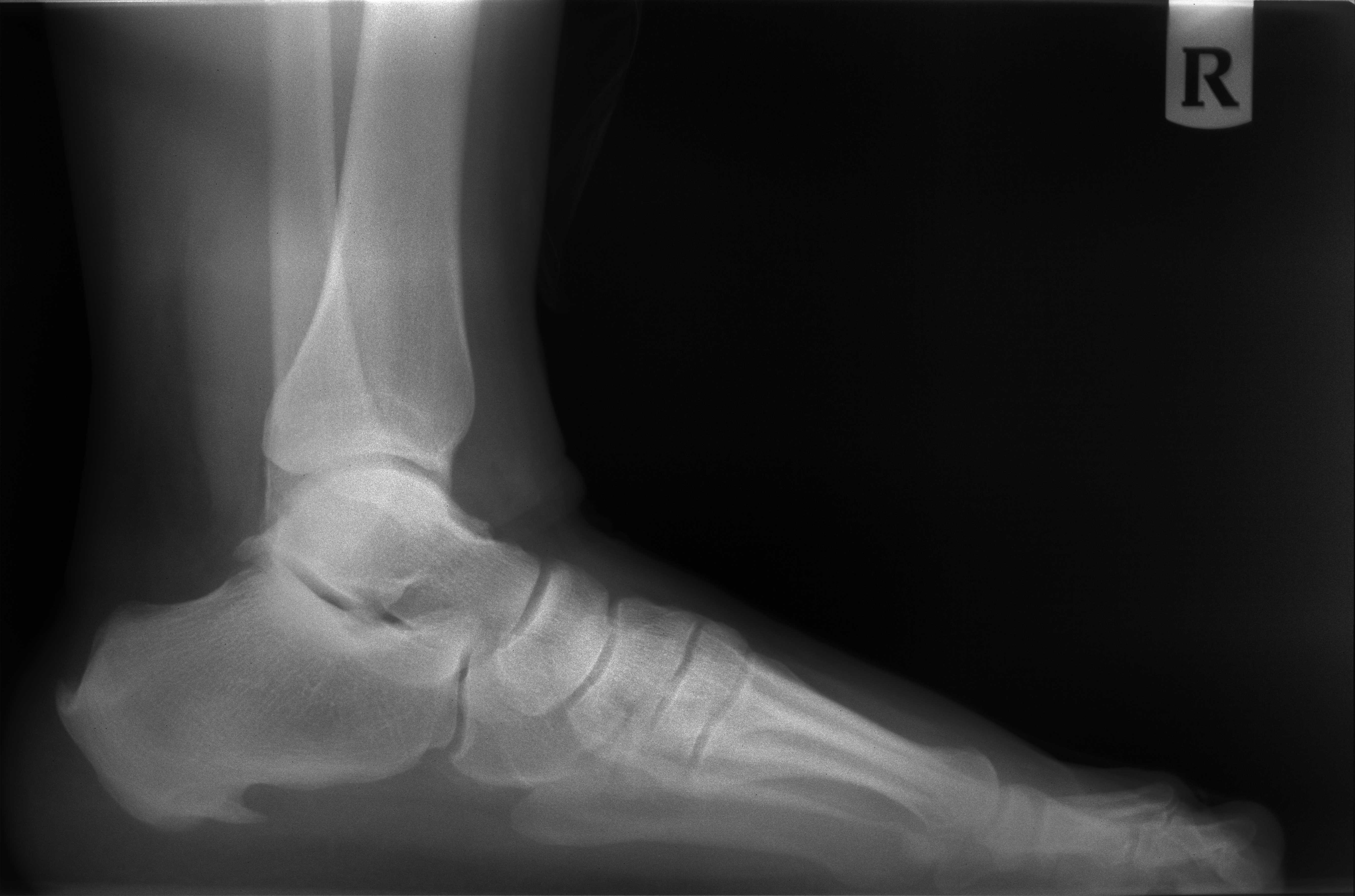 Wedge Osteotomy for Haglund's Syndrome and Associated Achilles Tendinosis -  Penn Physician VideoLink