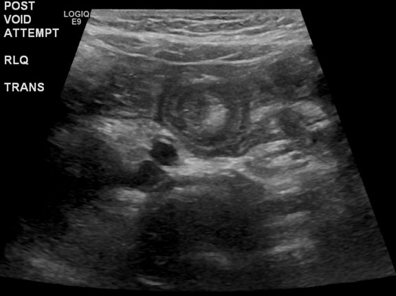 Volvulus Ultrasound