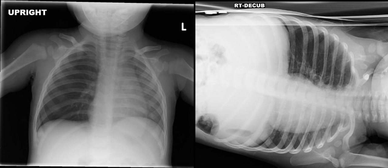 Chest X-ray of a patient with a bronchial foreign body